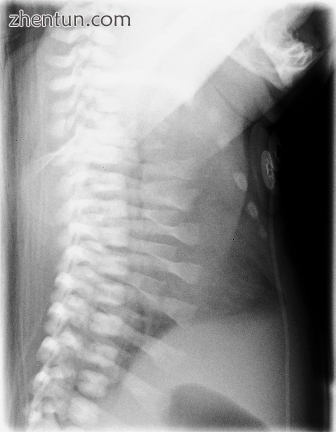 Lateral CXR of the same person above..png