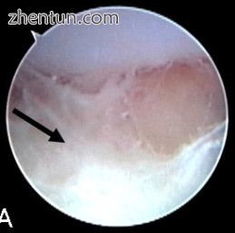 Septic arthritis as seen during arthroscopy[1].jpg