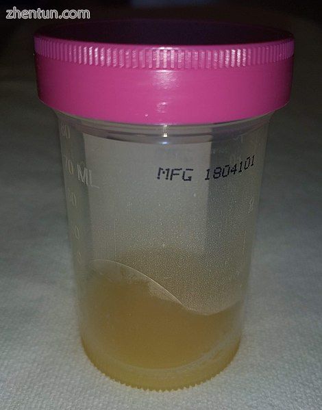 Synovial fluid from a septic knee.jpg