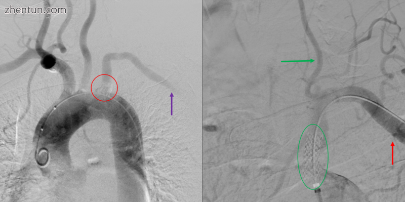 Angiogram of subclavian steal phenomenon before and after stent placement.PNG