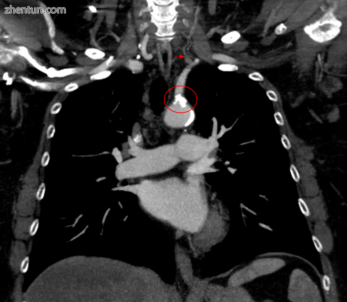 CT angiography of subclavian steal phenomenon.PNG