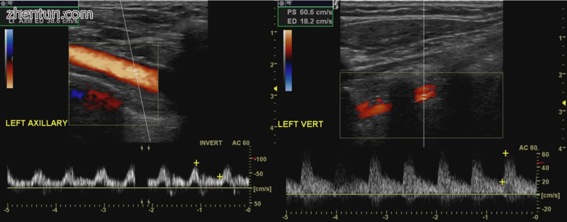 Doppler Ultrasound of subclavian steal phenomenon.PNG