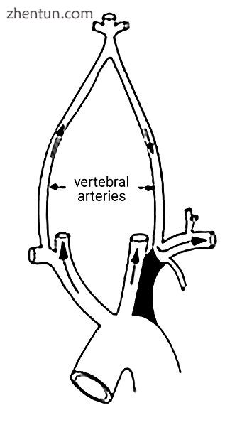 The proximal part of left subclavian is blocked on left side so no flow in verte.jpg