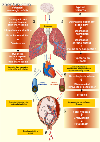 Pathophysiology of the amniotic fluid embolism.png