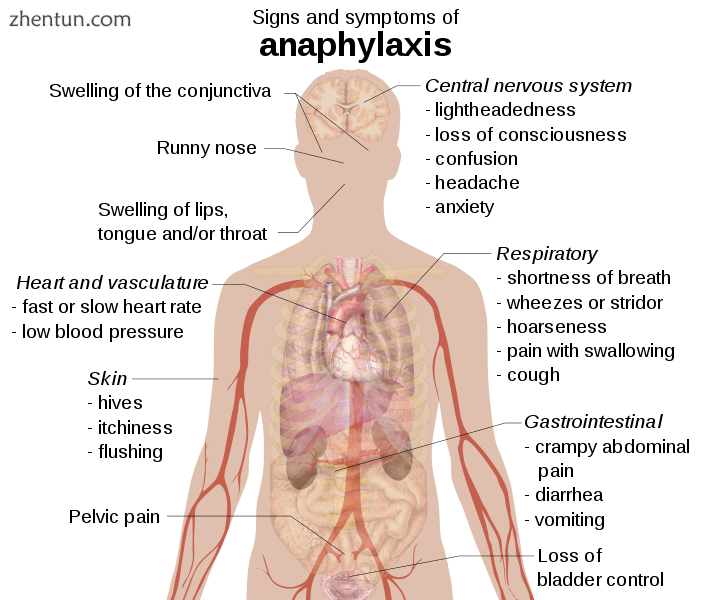 Signs and symptoms of anaphylaxis..png