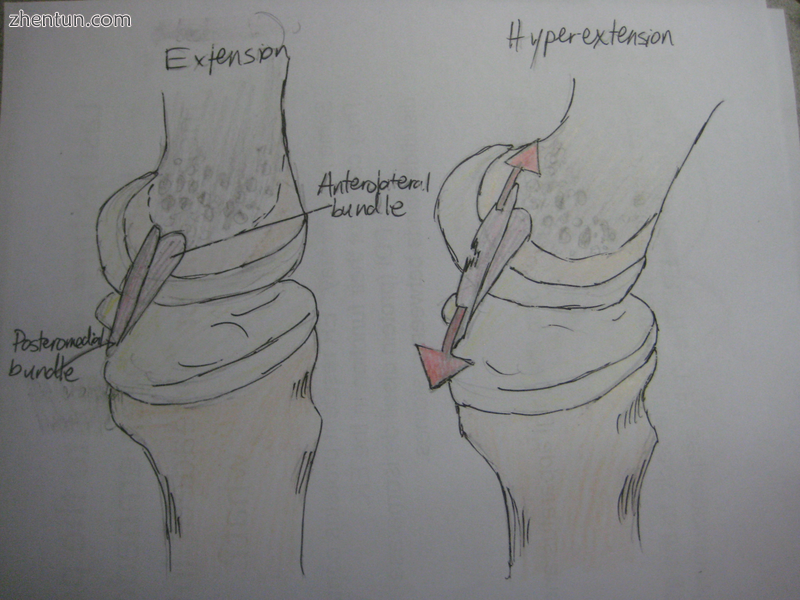 In this medial view of the extended knee, the lateral femoral condyle has been r.png