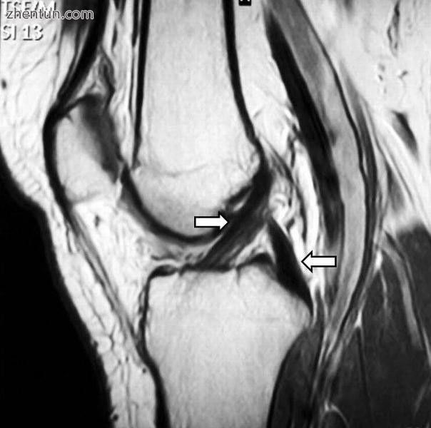 Magnetic resonance imaging evaluation demonstrating normal signal of both anteri.jpg