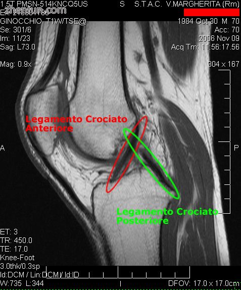 Cruciate ligaments.jpg