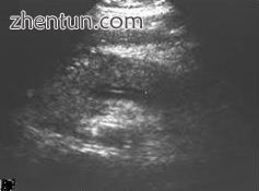 Abdominal ultrasonography of acute pancreatitis..jpg