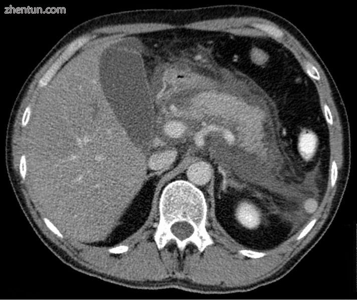Axial CT in a patient with acute exudative pancreatitis showing extensive fluid .jpg
