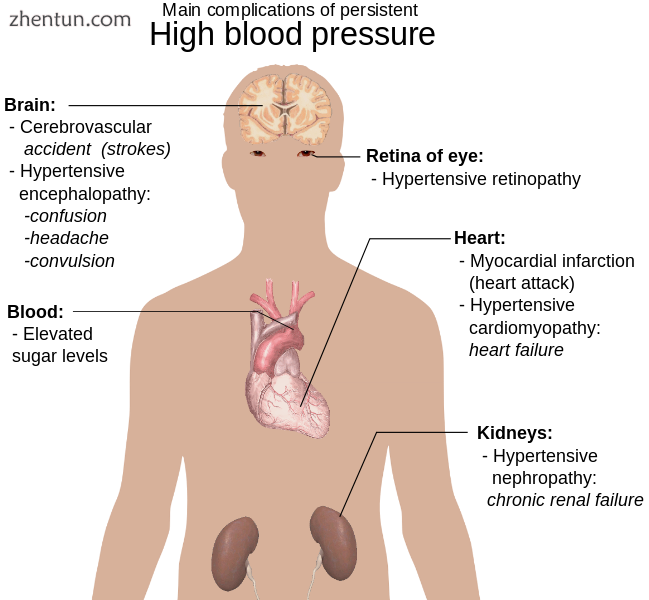 Diagram illustrating the main complications of persistent high blood pressure.png