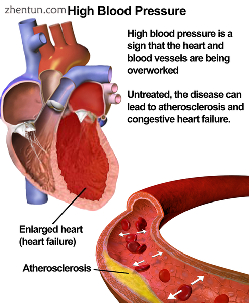 Illustration depicting the effects of high blood pressure.png