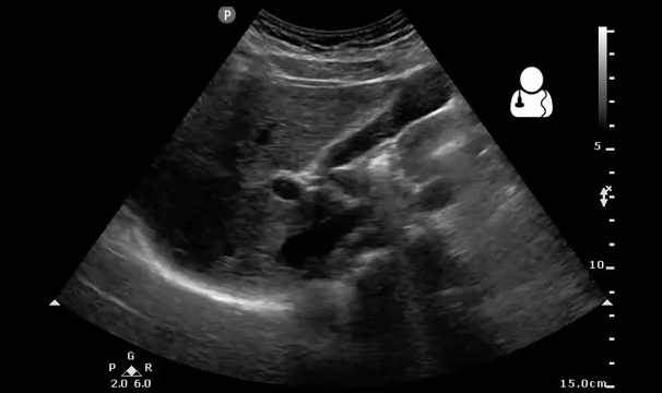 A normal gallbladder on ultrasound with bowel peristalsis creating the false app.gif