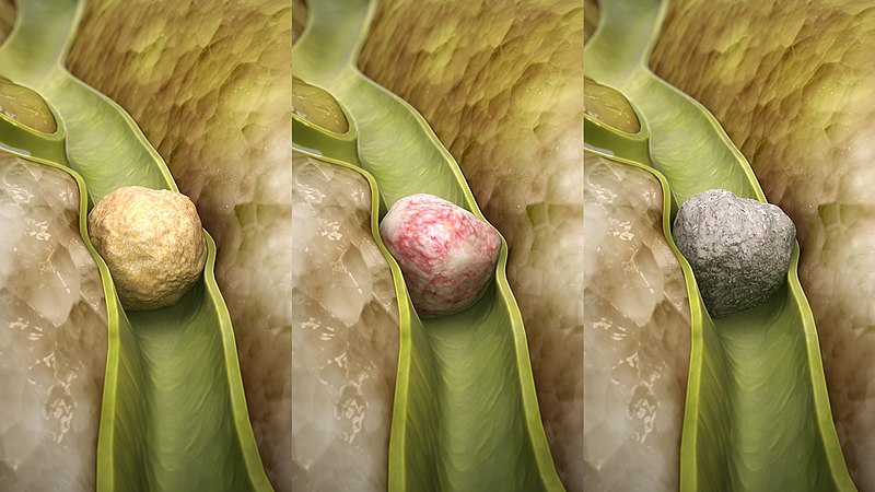 From left to right cholesterol stone, mixed stone, pigment stone..jpg