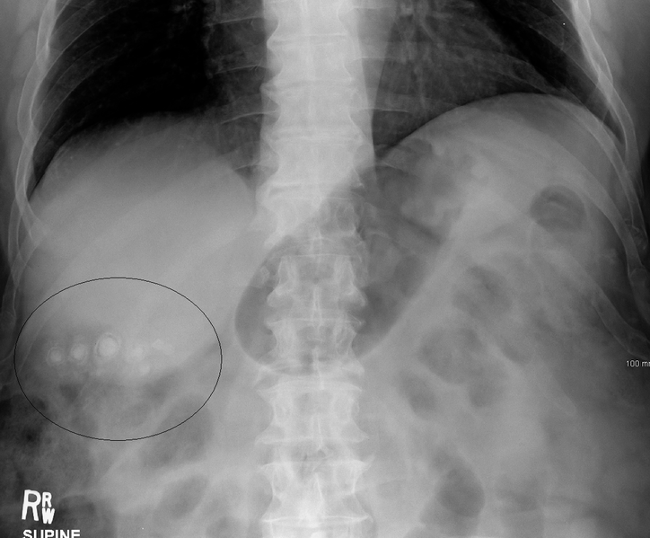 Gallstones as seen on plain X-ray.PNG