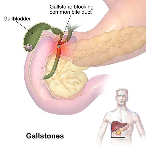 Gallstones.png