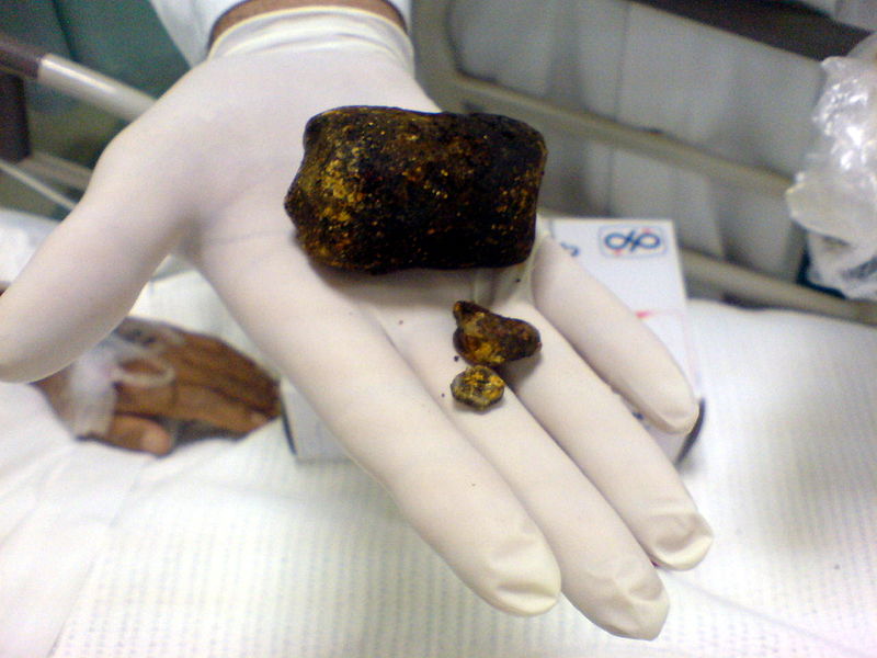 Large gallstone.JPG