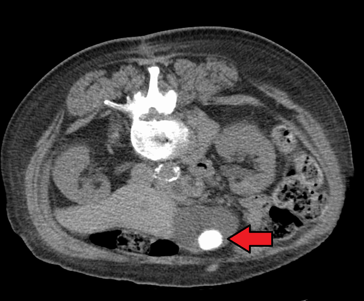 Large gallstone as seen on CT.png