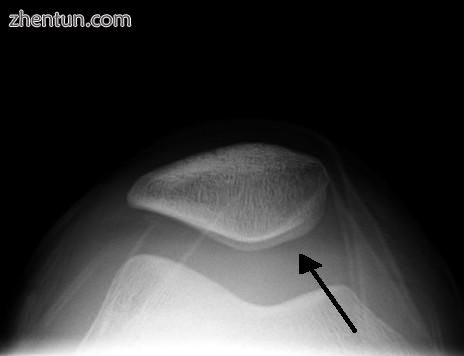 Skyline view of the patella demonstrating a large joint effusion as marked by th.jpg