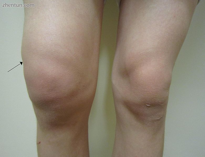 Traumatic effusion of the right knee, with swelling lateral to the kneecap marke.jpg