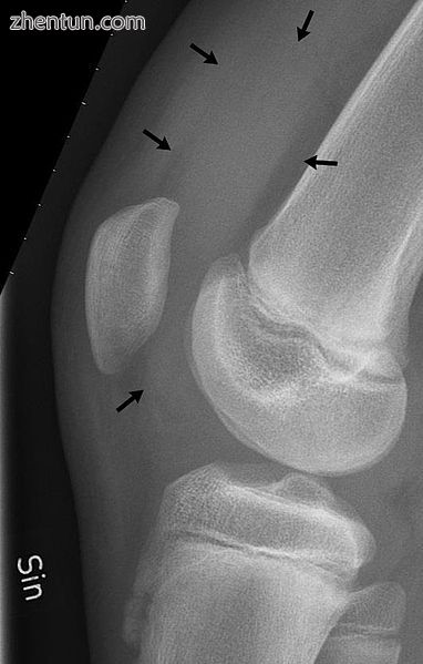 X-ray of the knee of a 12 year old male, showing knee effusion of medium severit.jpg