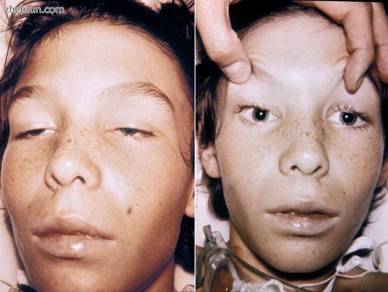 Neurotoxic ptosis caused by botulinum toxin.JPG