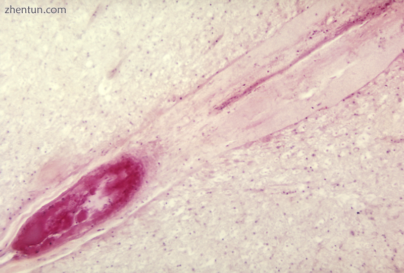 A blockage of the lumbar anterior spinal cord artery due to polio (PV3).png