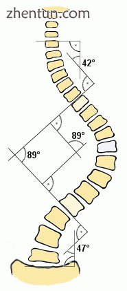 Cobb angle measurement of a scoliosis.gif