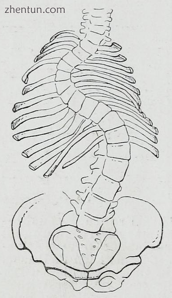 A 20th-century illustration of a severe case of a.png