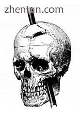 The skull of Phineas Gage, with the path of the iron rod that passed through it .jpg