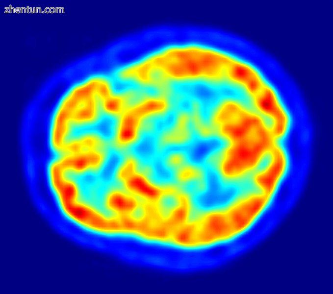 PET image of the human brain showing energy consumption.jpg