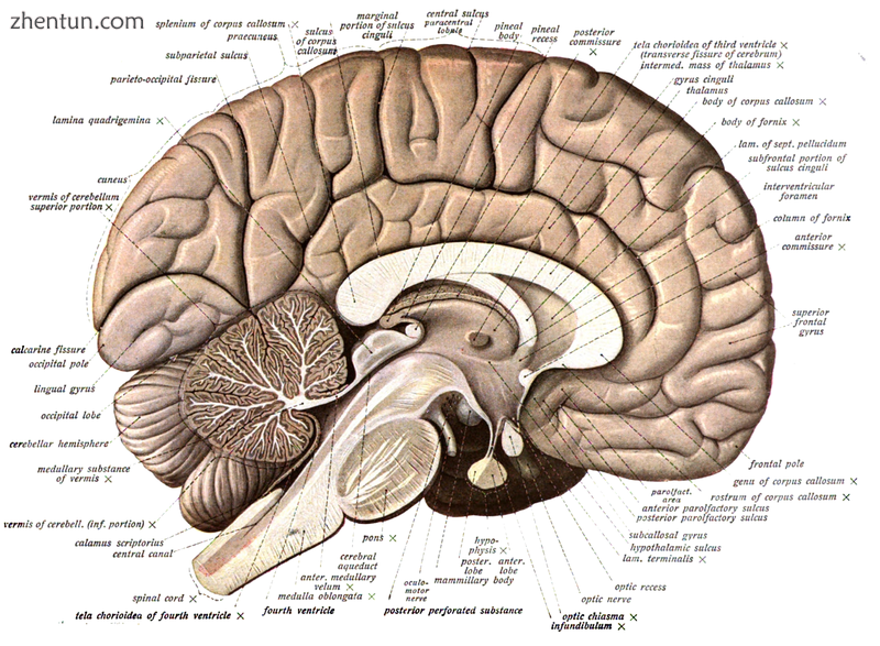 Human brain bisected in the sagittal plane, showing the white matter of the corp.png
