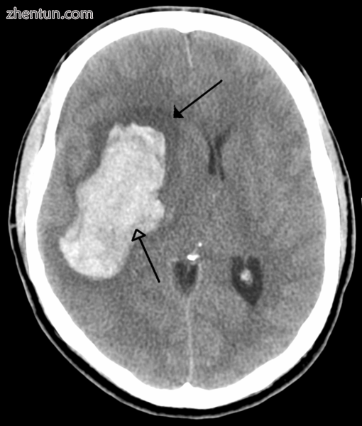CT scan of a cerebral hemorrhage, showing an intraparenchymal bleed (bottom arro.png