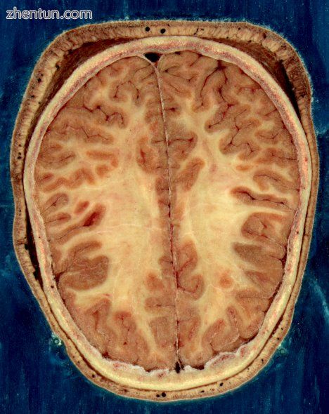 Cortical folds and white matter in horizontal bisection of head.jpg
