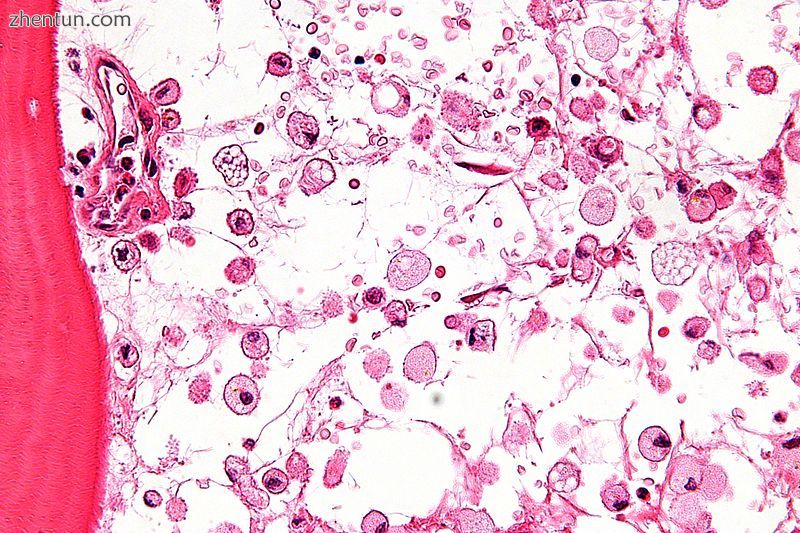 Micrograph showing crinkled paper macrophages in the marrow space in a case of G.jpg