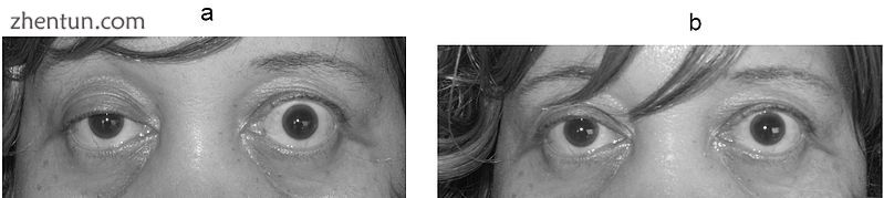 Photograph of a patient showing right partial ptosis (left pic.jpg