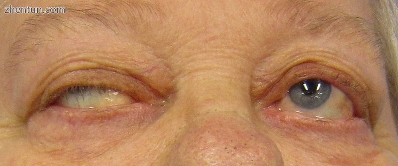 Eye deviation and a drooping eyelid in a person with myasthenia gravis trying to.jpg