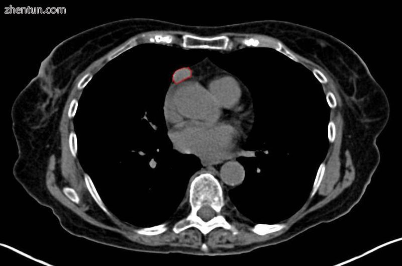A chest CT-scan showing a thymoma (red circle).JPG