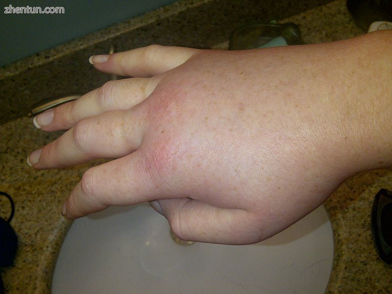 Swollen right hand during a hereditary angioedema attack..jpg