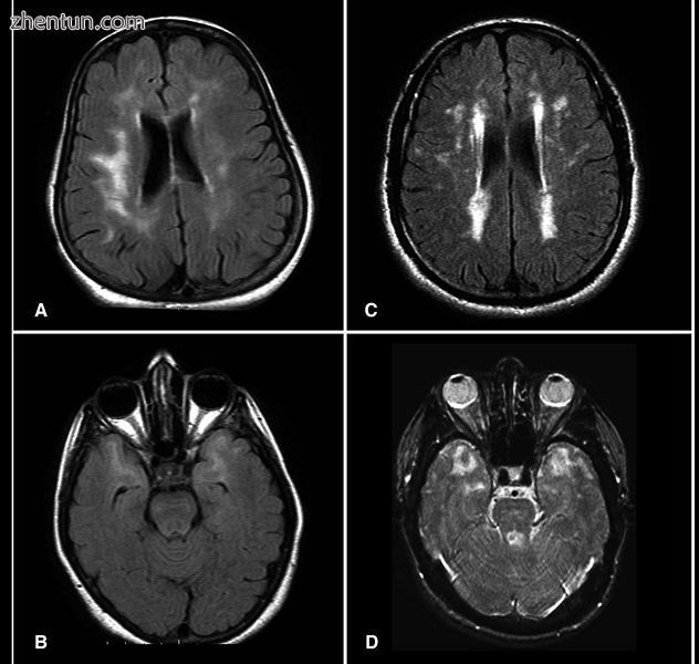 Brain MRI from patients with CADASIL showing multiple lesions..jpg