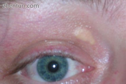 Xanthelasma palpebrarum, yellowish patches consisting of cholesterol deposits ab.jpg