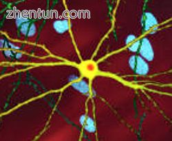 A microscope image of a neuron with inclusion (stained orange) caused by HD, ima.jpg