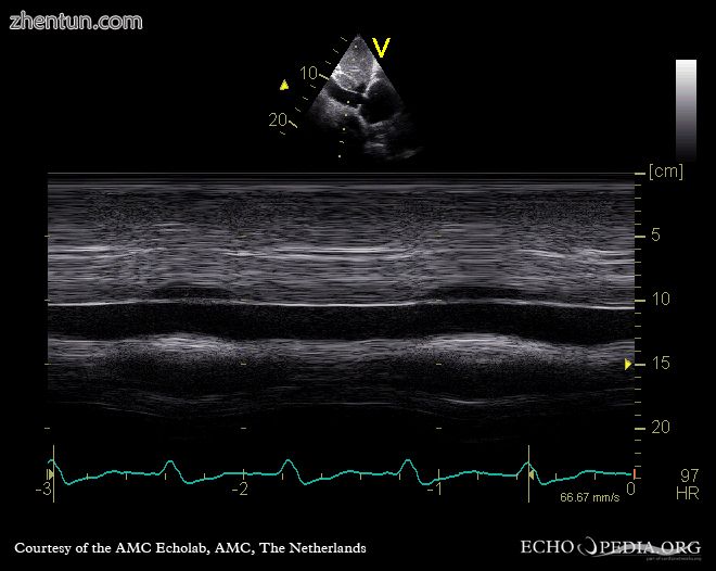 Severe tricuspid regurgitation.jpg