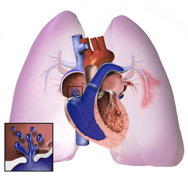 Pulmonary hypertension.png