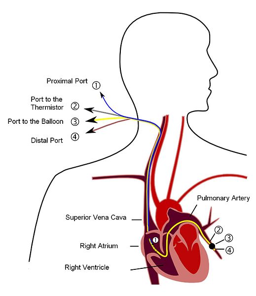 Pulmonary artery catheter.JPG