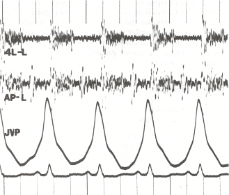Phonocardiogram and jugular venous pulse tracing from a middl.jpg
