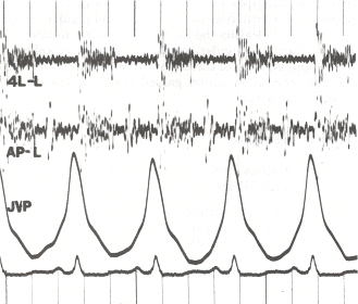 Phonocardiogram and jugular venous pulse tracing from a middl.jpg