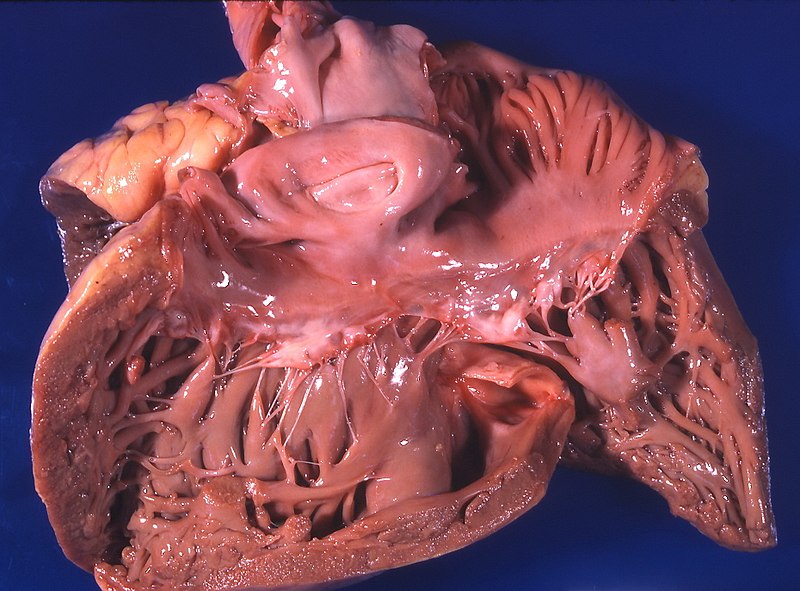 Cor pulmonale.jpg