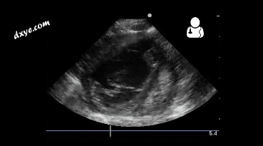 2-4 month old with pulmonary hypertension as seen on ultrasound[58].gif