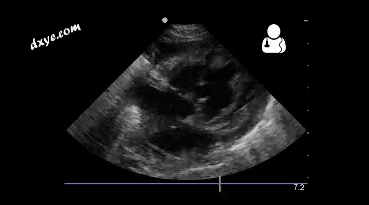 1-4 month old with pulmonary hypertension as seen on ultrasound[58].gif